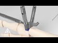 Trilliant Surgical - Minimally Invasive Bunion Plating System - 3D Medical Animation