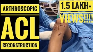 ACL Reconstruction (ALL YOU NEED TO KNOW)