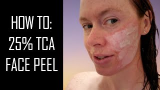 HOW TO DO A 25% TCA PEEL - Chemical Peel Skincare Tutorial