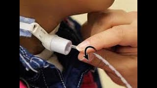 tracheostomy  suction------العنايه التمريضية لانبوب الفتحة العنقية الرغامية