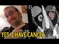 Yes, I Have Cancer.