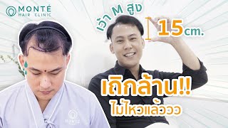 แนวผมล่นสูงลึก 15cm ทำเสียความมั่นใจ ปลูกผมเทคนิค MSAT