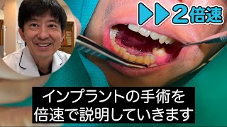 インプラント手術【倍速解説】実際の手術の様子を解説《交通事故で下顎６番目の歯を失った学生》