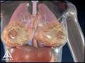 Breast Cancer Biopsy - 3D Medical Animation