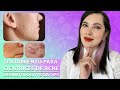 Como se tratan las CICATRICES DE ACNÉ. Tips de una Dermatóloga 👩🏻‍⚕️