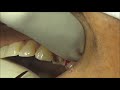 Extraction of Root canal treated Premolar