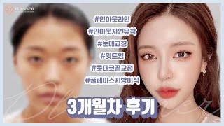 [닥터플래너 tv] 수술후 제 직업이 모델로 바뀌었어요!!(feat.섹시미 철철~~) | 자연유착 | 콧대 코끝 풀페이스지방이식  | 눈코수술 3개월 리뷰