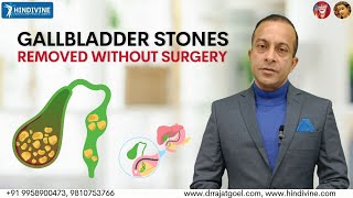 Can you remove Gall Bladder Stones without surgery ? | Gallstones Treatment in Delhi |Dr. Rajat Goel