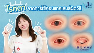 อันตราย! โรคตา จากการใช้คอนแทคเลนส์ผิดวิธี 👁 | We Mahidol