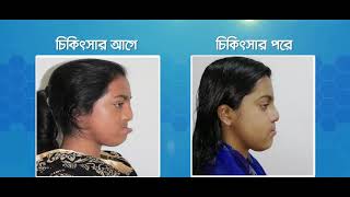 জন্মগত ঠোঁট কাটা রোগের চিকিৎসা ( Lip Surgery)