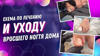 Схема по лечению и уходу вросшего ногтя дома / Лечение в домашних условиях #лечение #вросшие #дом