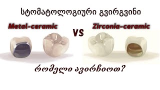 სტომატოლოგიური გვირგვინები – ცირკონ-კერამიკული VS მეტალო-კერამიკული