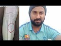 हड्डी का टुकड़ा जुड़ा नहीं है tibia fibula fracture recovery बहुत कठिन मामला बनाया skin grafting