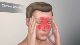 What is Chronic Sinusitis?