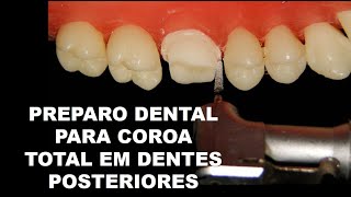 PREPARO PARA COROA TOTAL EM DENTES POSTERIORES