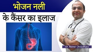 एसोफाजाल कैंसर | भोजन नली का कैंसर | Esophageal Cancer | Esophageal Cancer Best Treatment