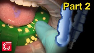 HOW TO Take Closed Tray #Implant Impression for Tooth #19