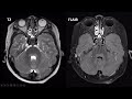 imaging of viral encephalitis part 3 less frequent viral encephalitides