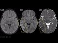 imaging of viral encephalitis part 3 less frequent viral encephalitides