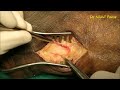 Tarsal tunnel release