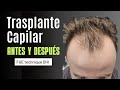 TRASPLANTE CAPILAR | 3.178 UF's | Hair Transplant before after | Hair Transplant results