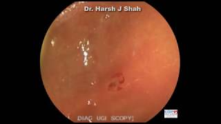 Antral Gastritis UGIE Series Dr Harsh Shah