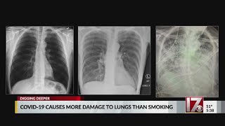 COVID-19 infected lungs damaged more than smoker’s lung, doctor says