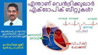 എന്താണ് വെൻട്രിക്കുലാർ എക്ടോപിക് ബീറ്റുകൾ (മിസ്ഡ് ബീറ്റ്)?