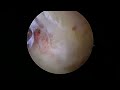 minimally invasive knee surgery removal of a massive loose body in the back of the knee