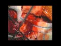 Download Dr. Ali Bydon Performs Spinal Tumor Surgery at Johns Hopkins In Mp4 3Gp Full HD Video