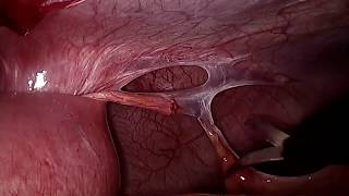 Intestinal Obstruction - Laparoscopic adhesiolysis