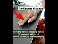 Pill-rolling Tremors- Parkinson's Disease