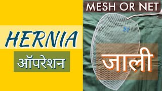 Hernia Treatment - 3D Mesh