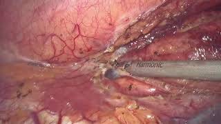 esophagectomy after neoadjuvant chemoradiotherapy 新辅助放化疗后食管癌根治术