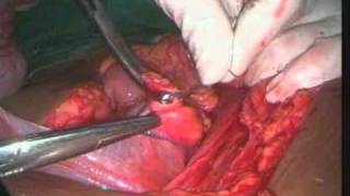 Large Ovarian mass ,laprotomy,drvahabkp