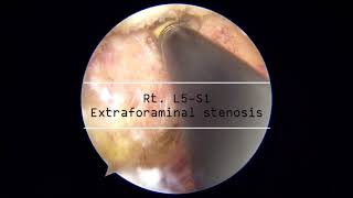 UBE L5-s1 extraforaminal stenosis (far-out band)