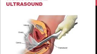 DAROGA Early Pregnancy. Part 1: Normal signs, symptoms, beta hCG levels and Ultrasound findings.