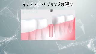 インプラント ブリッジ 費用｜東京の名医日本橋インプラント玉木仁院長