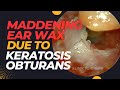 MADDENING Ear Wax Removal Due To Keratosis Obturans