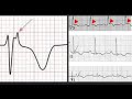 epsilon wave u0026 its causes. ecg