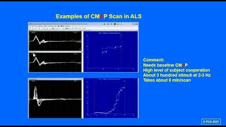 High Density Surface EMG Based CMAP Scan for Motor Unit Number Estimation (Signal Analysis Study)
