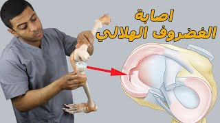 اصابة الغضروف الهلالي/أفضل7 تمارين لعلاج اصابة قطع الغضروف الهلالي نهائيا