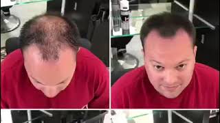 Hair Fiber Demonstration (DermMatch Hair Fibers vs Hair3)