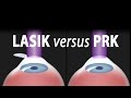 LASIK or PRK? Which is right for me? Animation. LASIK or PRK? Which is right for me? Animation.