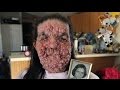 Bubble Gran, Woman Covered In Benign Tumours: Body Bizarre Episode 5