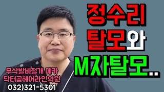 정수리탈모와 M자탈모.