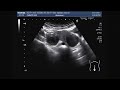 ultrasound video showing bilateral ovarian cysts.