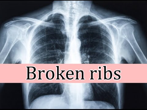 Broken ribs, symptoms and treatment Broken ribs, symptoms and treatment
