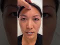 Confused about whether you need a brow lift or blepharoplasty (upper eyelid lift)