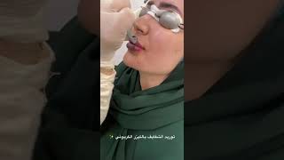 توريد الشفايف وعلاج التصبغات بالليزر ( التقشير الكربوني بالليزر) في عيادات الشاكرين